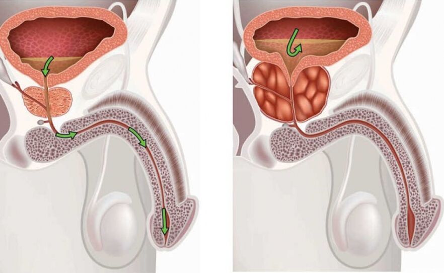 gesunde und entzündete Prostata