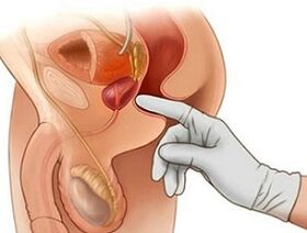 Prostatamassage zur Behandlung von Prostatitis bei Männern