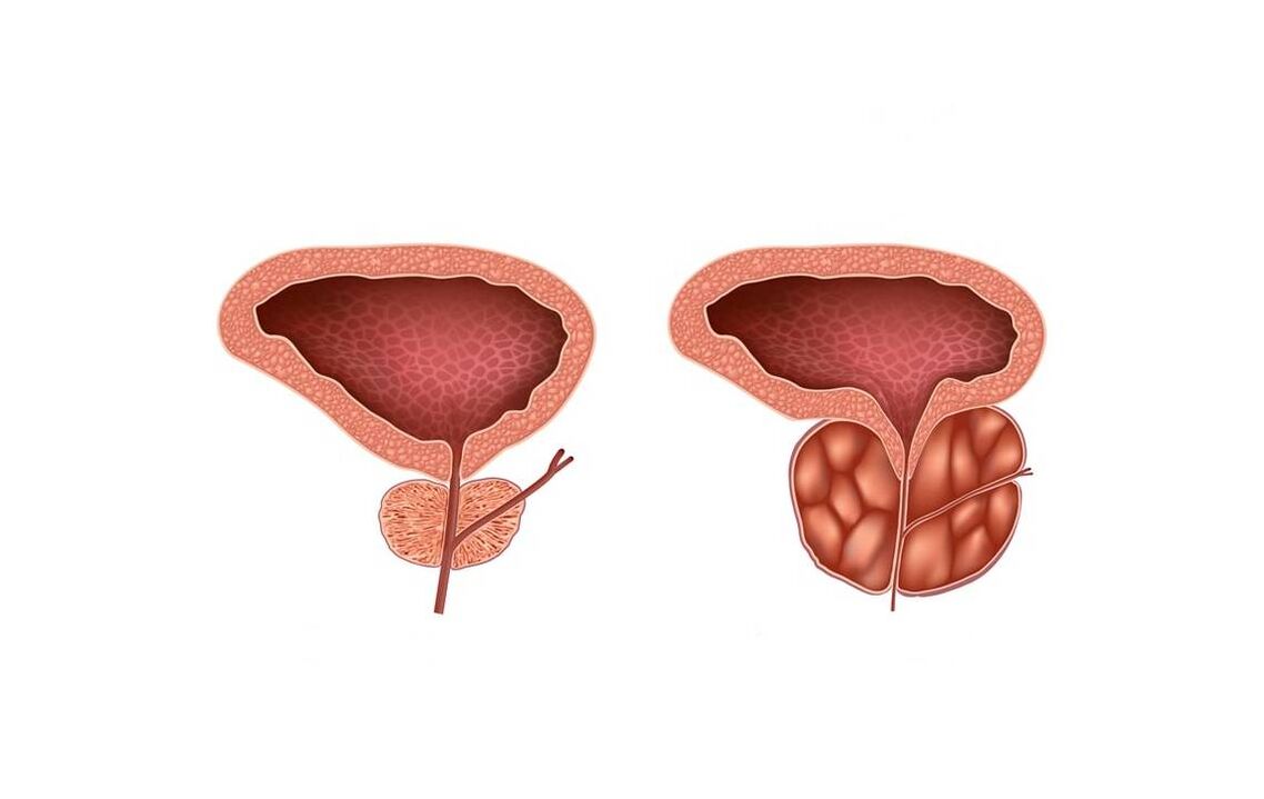 Symptome einer Prostatitis bei Männern