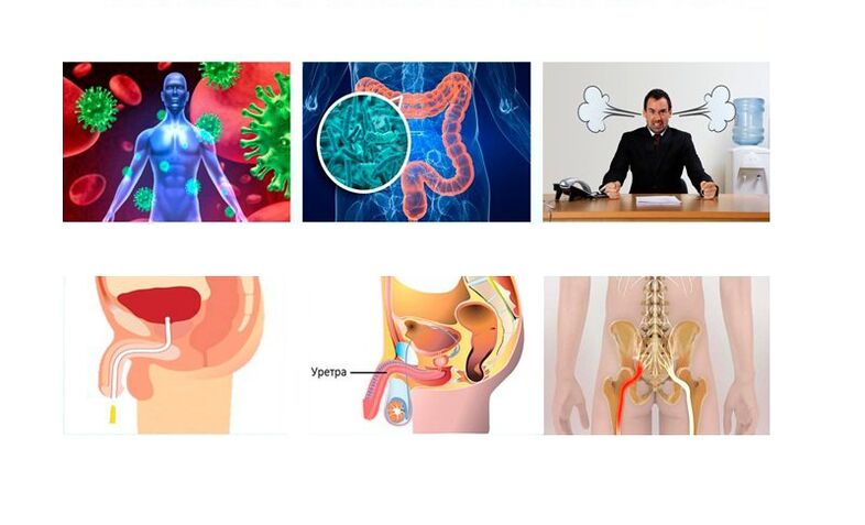 Ursachen der Prostatitis