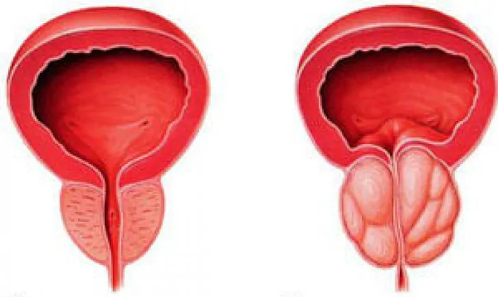 Normale Prostata (links) und entzündete chronische Prostatitis (rechts)