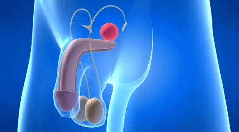 Prostatitis ist eine Entzündung der Prostata bei Männern, die eine komplexe Behandlung erfordert